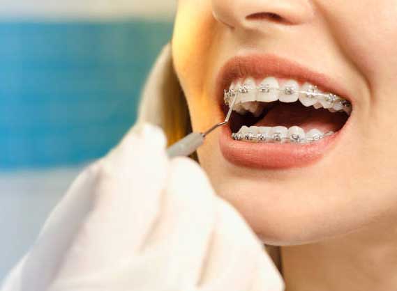 брекет-системы исправление неправильного прикуса зубов