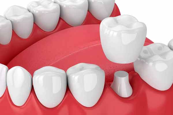 Металлокерамика, керамика или цирконий: что лучше для протезирования